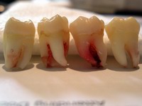 set of four wisdom teeth